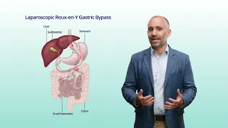 Roux en y gastric bypass surgery