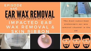 IMPACTED EAR WAX REMOVAL & SKIN RIBBON - EP446