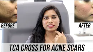 TCA Cross (Acne Scar Treatment)