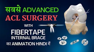 सबसे Advanced #ACL Surgery with FiberTape Internal Brace का #Animation in Hindi @OrthoIllustrated