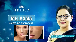 What is Melasma? | Melasma Treatment Explained | Dr M Shraddha | Dermatologist