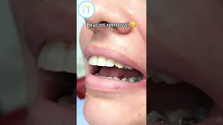 Braces Removal process🦷😬 #braces #bracesoff #dentist #teeth