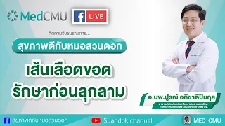 สุขภาพดีกับหมอสวนดอก ตอน “เส้นเลือดขอด” รักษา..ก่อนลุกลาม