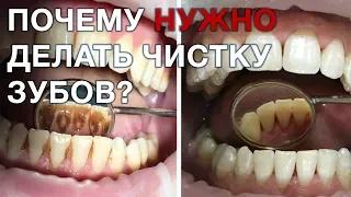 Что такое зубной камень? Как удаляют зубной камень?