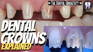 DENTAL CROWNS! Patient's Request to Make Her Teeth Uniform #4k #c34