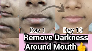 தமிழில் /How to Remove Pigmentation, Dark patches Around Mouth || 100% Result in 10 days