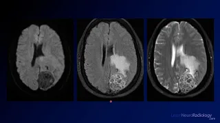 Neuroradiology Board Review - Brain Tumors - Case 14