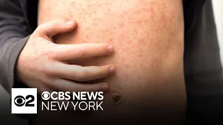 Rising measles cases threaten virus's elimination status in the U.S.