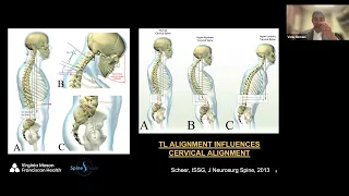 Cervical Deformity – Surgical Decision Making Principles presented by Venu Nemani, MD