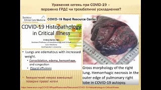Ураження легень при COVID-19 – що первинно ГРДС чи тромботичні ускладнення?