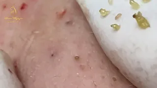 A lot of blackheads on the female client's face (352b) | Loan Nguyen