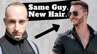 Extreme Hair Loss Transformation | Expert Advice with MattDominance | PART 2