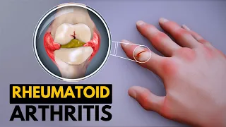 Rheumatoid Arthritis, Causes, Signs and Symptoms, Diagnosis and Treatment.