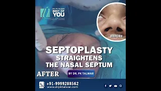 Septoplasty Surgery Results , Nose Job Surgery Results in Delhi by Dr. PK Talwar