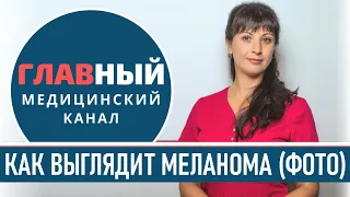 Как выглядит МЕЛАНОМА (фото 1-9). Симптомы и признаки меланомы. Как определить рак кожи