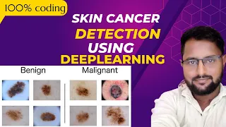 skin cancer detection using deeplearning python