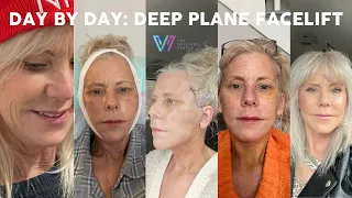 Day by Day Deep Plane Facelift Recovery