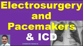 Electrosurgery and Pacemakers & ICD