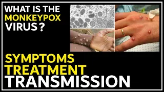 What is the Monkeypox Virus ? | Symptoms - Treatment - Transmission