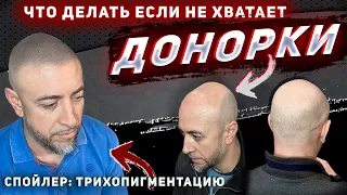 Что делать если не хватает донорки для пересадки волос? Трихопигментацию. Scalp Micropigmentation.