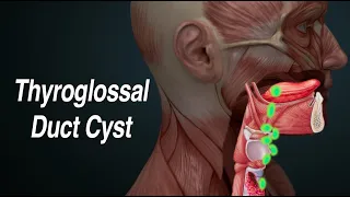 Thyroglossal Duct Cyst (Midline Neck Mass)