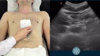 How to scan the abdominal aorta to assess for a potential AAA
