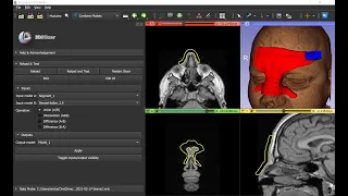 Combine patient and CAD models in 3D Slicer using union/intersection/difference operations