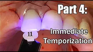 Easy Immediate Temporization on  abutment step by step