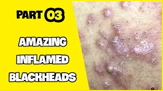 Suri Series 01: AMAZING INFLAMED BLACKHEADS POPPING | PART 3