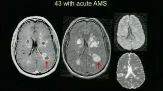 44   CNS Infections