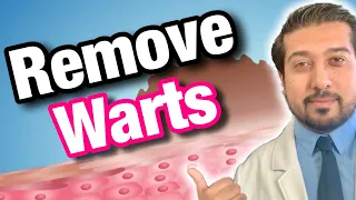 Wart Removal 101 | How to Get Rid of Warts