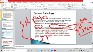 Monocular elevation deficiency