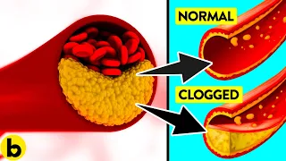 11 Foods To Avoid If You Want To Unclog Your Arteries