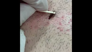 Tufted Ingrown Hair Removal