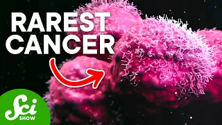 The Rarest Cancer on Earth: Only One Known Case