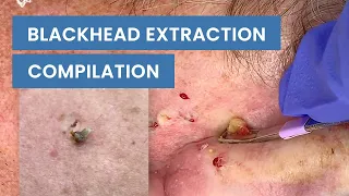 Extraction Satisfaction (Blackhead Removal) | CONTOUR DERMATOLOGY