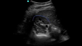 POCUS - Soft Tissue - Lymphadenopathy