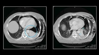 Mediastinal Trauma | Interesting Radiology Cases