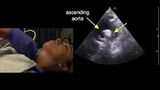 Suprasternal Echocardiography Scan Technique