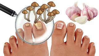 Do you suffer from nail fungus? You have to do this! VERY IMPORTANT TIP