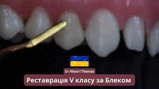 Реставрація 5 класу за Блеком