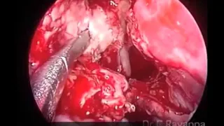 Endoscopic excision of ant clinoid mucocele