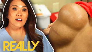 Dr. Lee Discovers What Caused This Fluid Mass On Delano’s Back! | Dr. Pimple Popper: This Is Zit