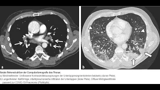 Lungenarterienembolie bei COVID-19 trotz Thromboseprophylaxe