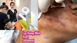 Acne treatment reputation, effective at Hien Van Spa|383I Lưu hoàng Minh-part-4