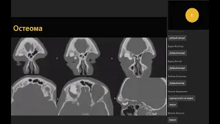 Компьютерная томография при опухолях придаточных пазух носа