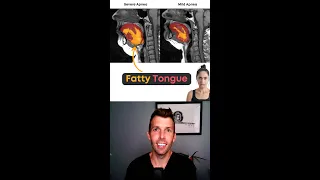 Fatty Tongue and Obstructive Sleep Apnea