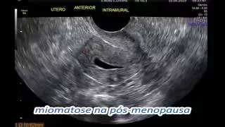 MIOMA UTERINO- MIOMATOSE UTERINA DIAGNÓSTICO ULTRASSONOGRÁFICO - ECOGRÁFICO - CLÍNICA SARRAFF