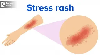 What is a stress rash? - Dr. Rajdeep Mysore