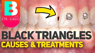 Tooth Gaps / Black Triangles with Braces or Invisalign